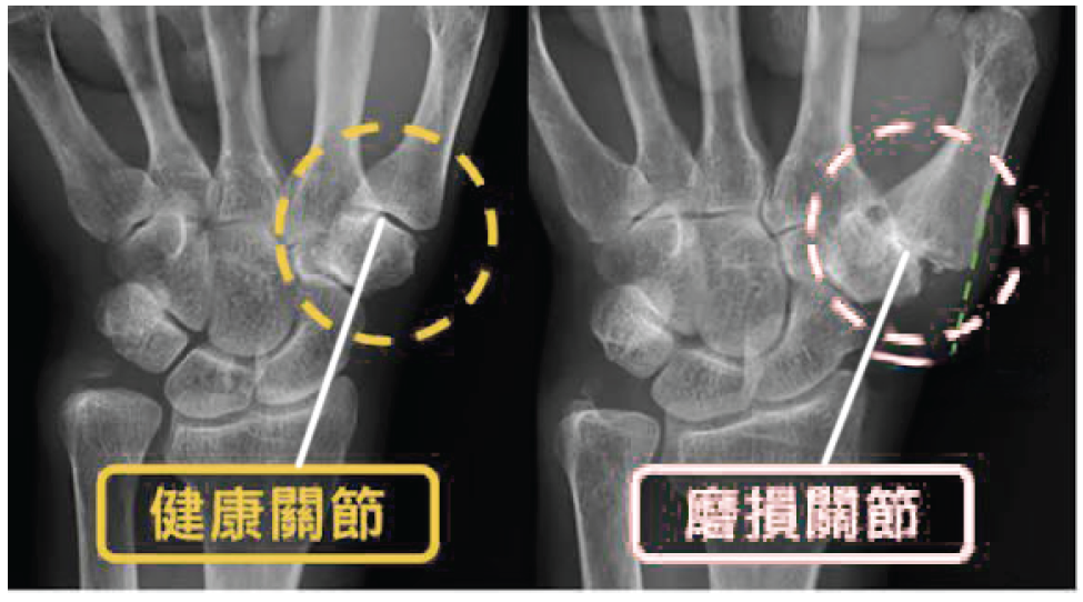 Thumb X-ray comparison
